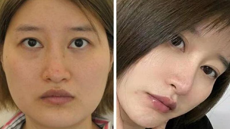 小标题：术后运动健身的注意事项