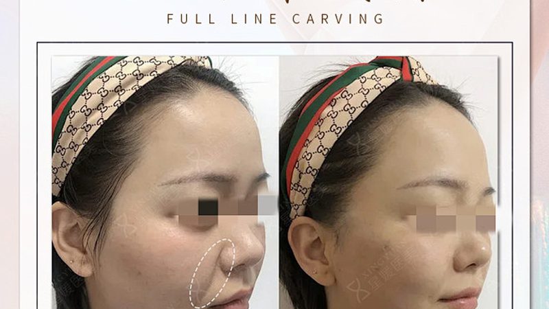 小标题：哺乳期，美容注射的隐忧