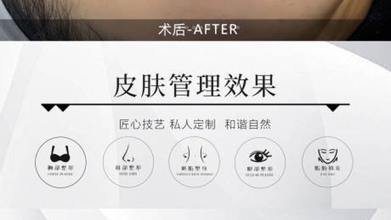 埋线提升法令纹，术后护理攻略揭秘