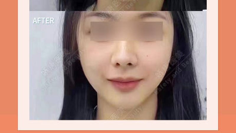 肉毒素注射，揭秘见效时间与关键步骤