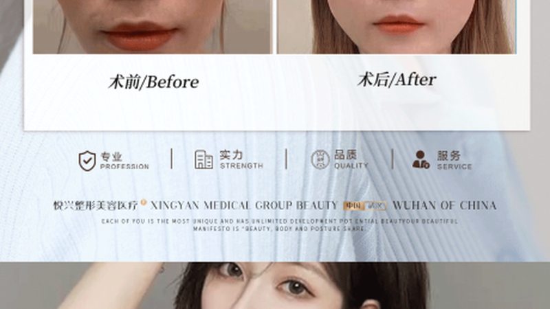 敏感肌能否用光子嫩肤仪：揭秘安全与适用性