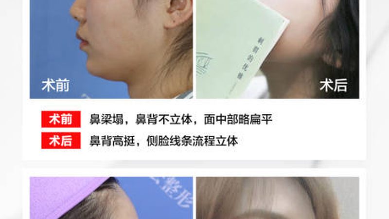激光祛斑后，饮食上有哪些禁忌？**