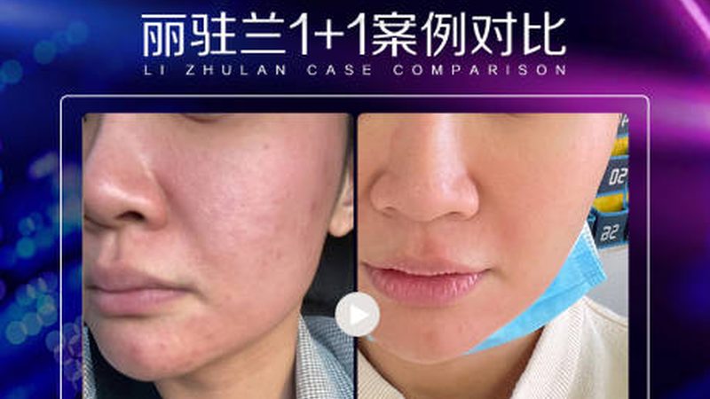 家用光子嫩肤仪十大品牌排名