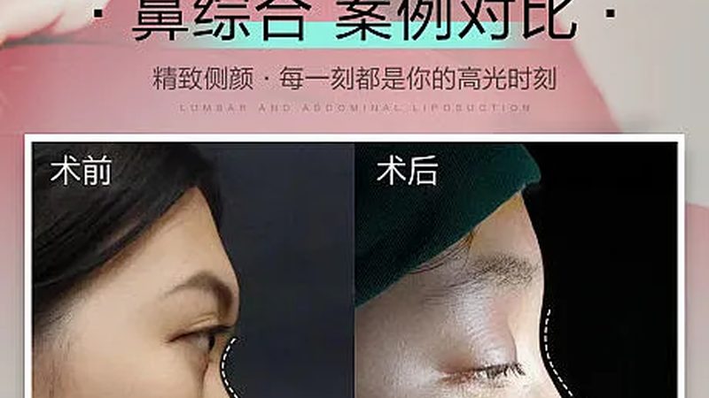 西安磨骨手术恢复期：揭秘术后恢复全流程
